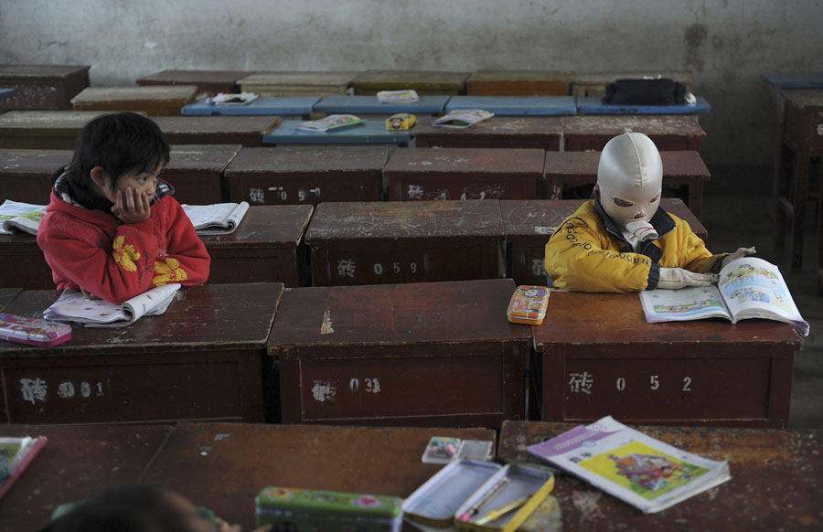 Ван Гэн Сян вынужден носить маску для защиты обожженной кожи лица от инфекций. © JIANAN YU/Reuters