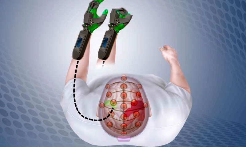 Устройство Ipsihand обнаруживает электрические сигналы в неповрежденной части мозга (зеленый), и приводит действие перчатку, надетую на парализованную руку (зеленый).