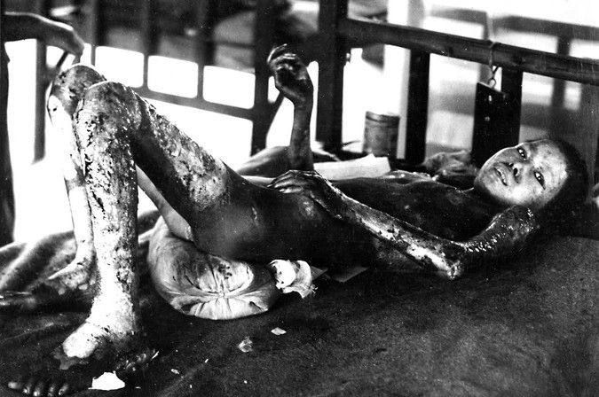 Японская девушка с ожогами 80% тела 3-4 степени. Она скончалась через несколько дней после удара.