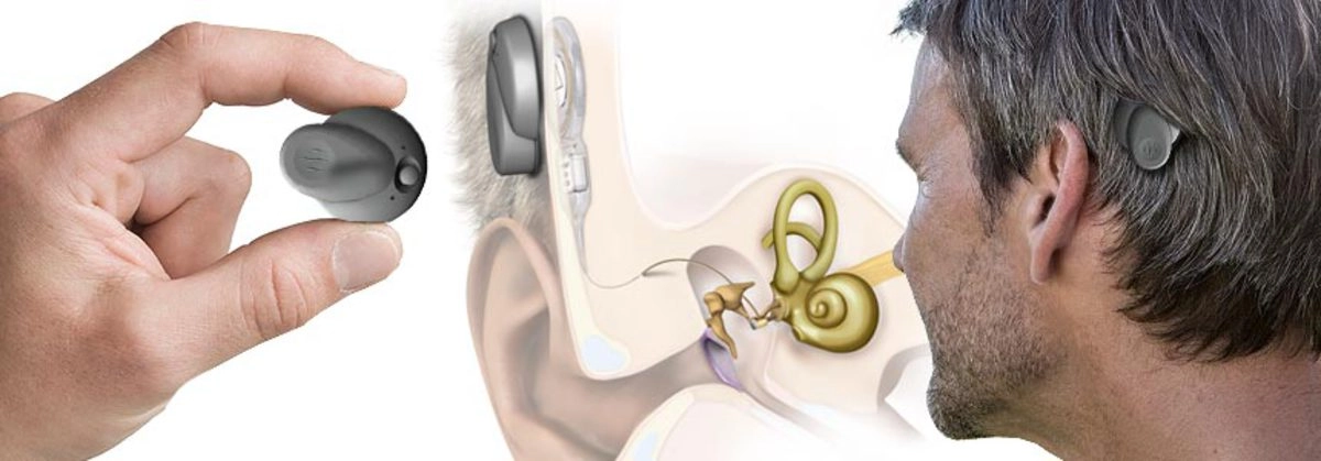 Ухо после шунтирования. Аппарат Cochlear кохлеарный Cochlear. Аппарат для глухих кохлеарная имплантация. Слуховой аппарат костной проводимости ponto. Кохлер слуховой аппарат.