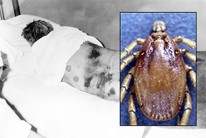 Пациент с Крымско-Конго геморрагической лихорадкой (К-ХСН) и клещ рода Hyalomma. Пациент с Крымско-Конго геморрагической лихорадкой (К-ХСН) и клещ рода Hyalomma.