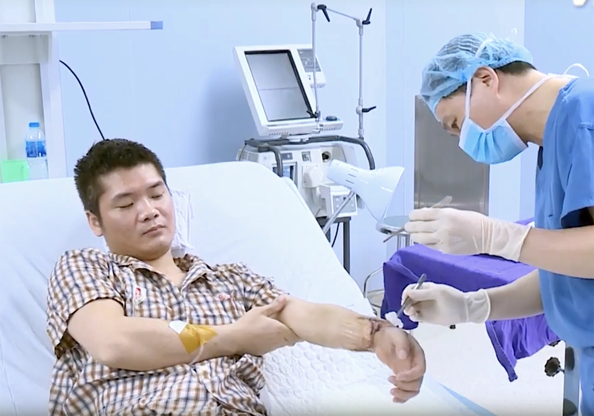 Пересадка 8 часов. Люди с пересаженными руками. Трансплантация руки в России.