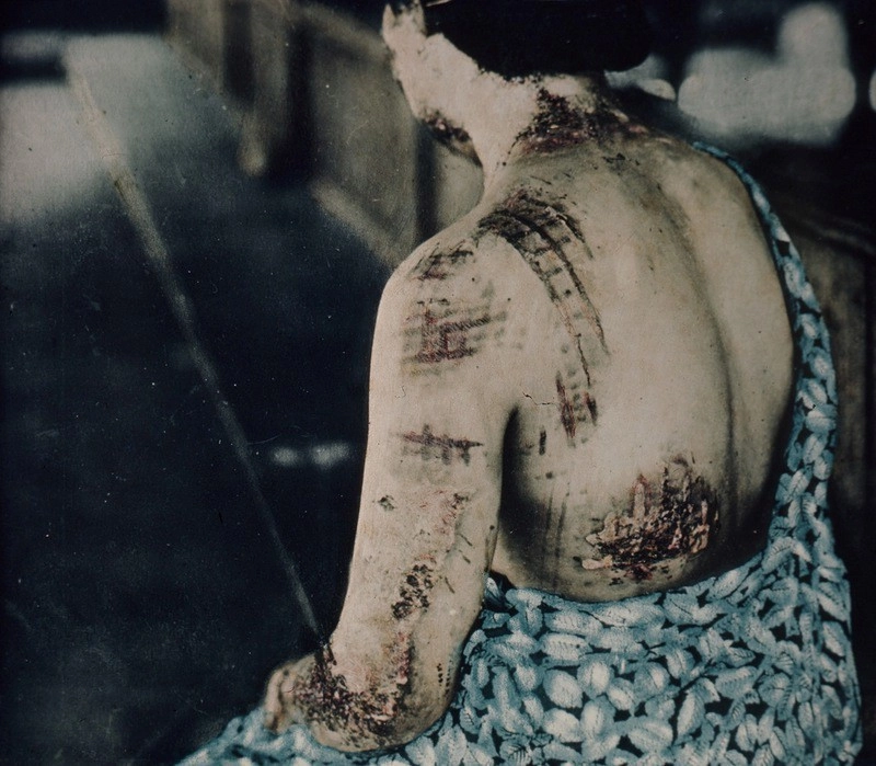 Акико Такакура. Ожоги на ее коже повторяют темные участки кимоно.