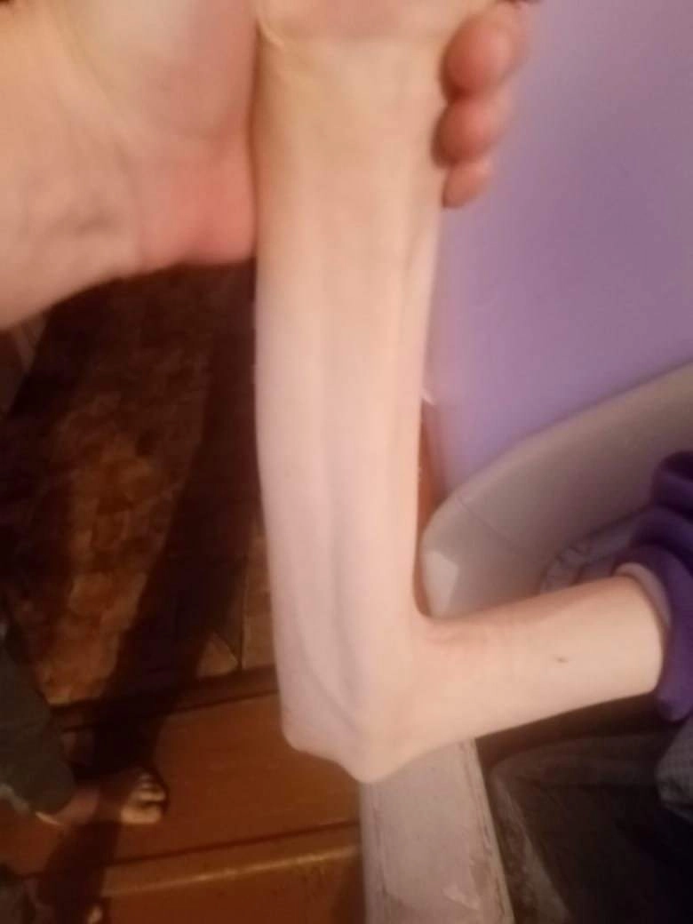 Ребенок находился в состоянии крайнего истощения организма Ребенок находился в состоянии крайнего истощения организма