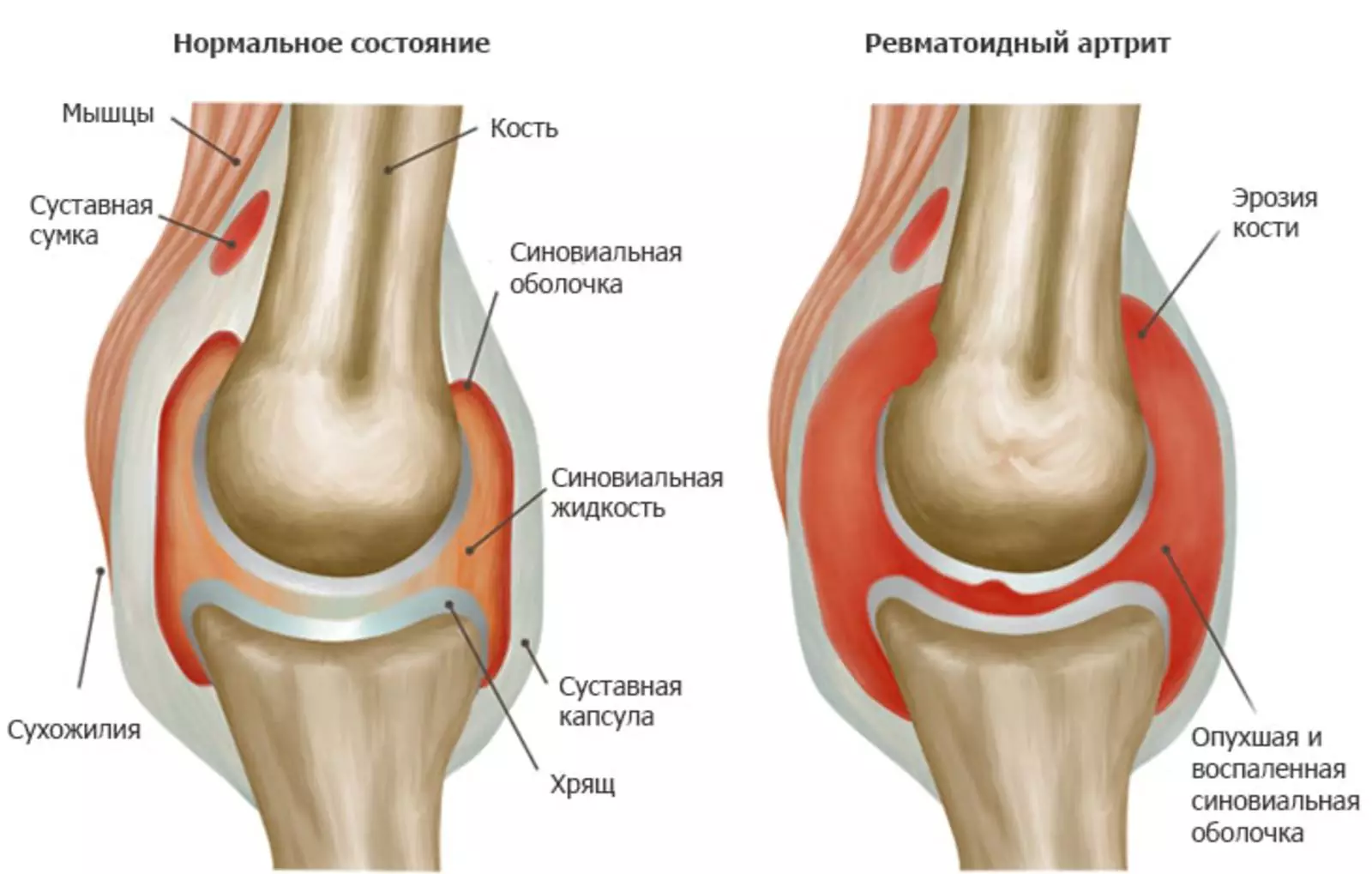 Ревматоидный артрит колена