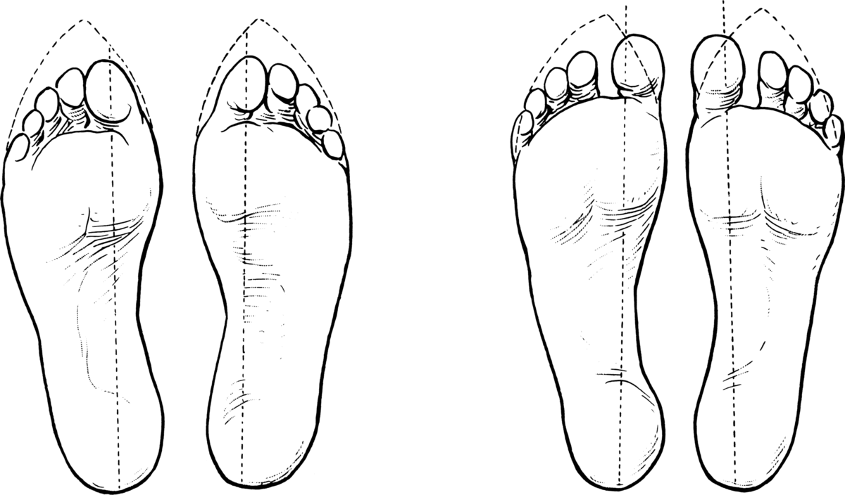 Положение пальцев в тесной обуви. Положение пальцев в тесной обуви.