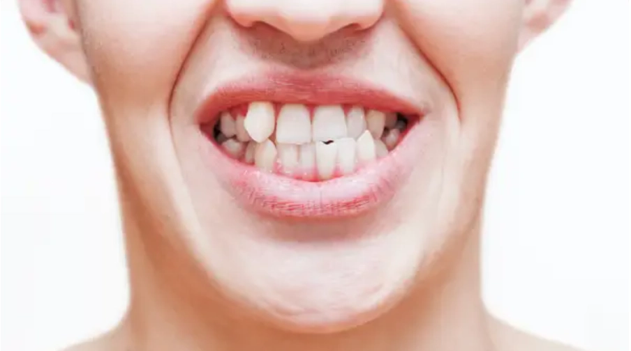 Люди не сталкивались с проблемой кривых зубов до появления сельского хозяйства. После того, как у человека изменилось питание, челюсти эволюционировали, став меньше, однако зубы остались прежних размеров. Поэтому у многих людей зубы “скручиваются” и “наезжают” друг на друга. 