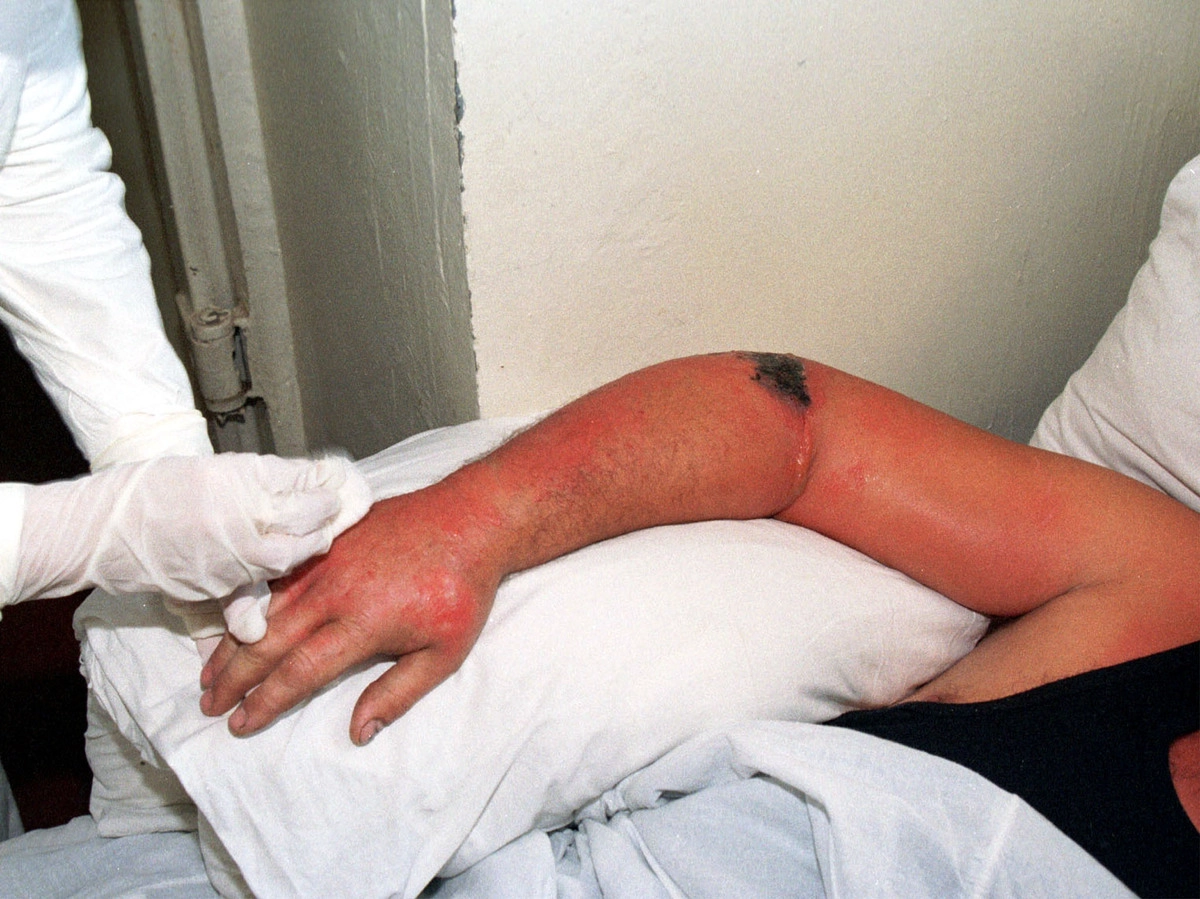 Больной кожной формой сибирской язвы © Владимира Зининa\TASS Больной кожной формой сибирской язвы © Владимира Зининa\TASS