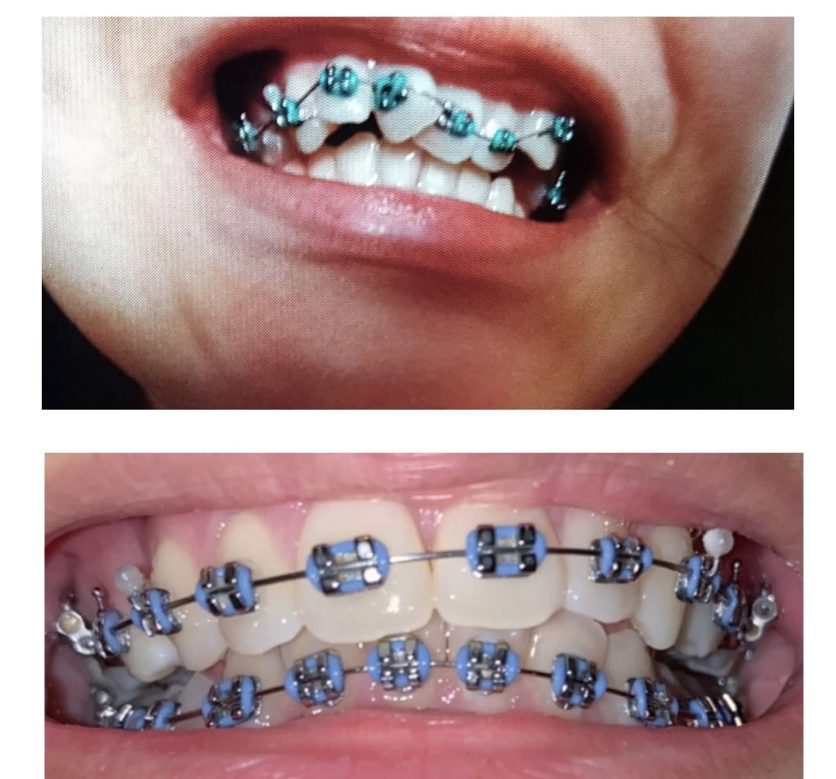 Брекеты при первой установке и восемь месяцев спустя. Брекеты при первой установке и восемь месяцев спустя.