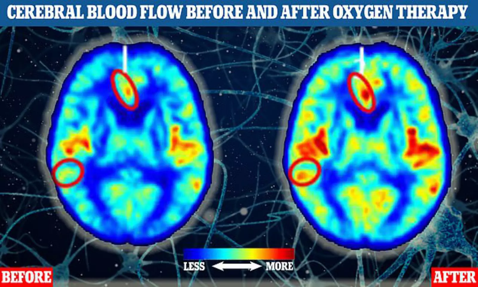 Два снимка МРТ головного мозга участников исследования показывают кровоток до (слева) и после (справа) одного из участников исследования кислородной терапии. Области, где больше желтых, оранжевых и красных тонов, указывают на более высокий уровень кровотока. 