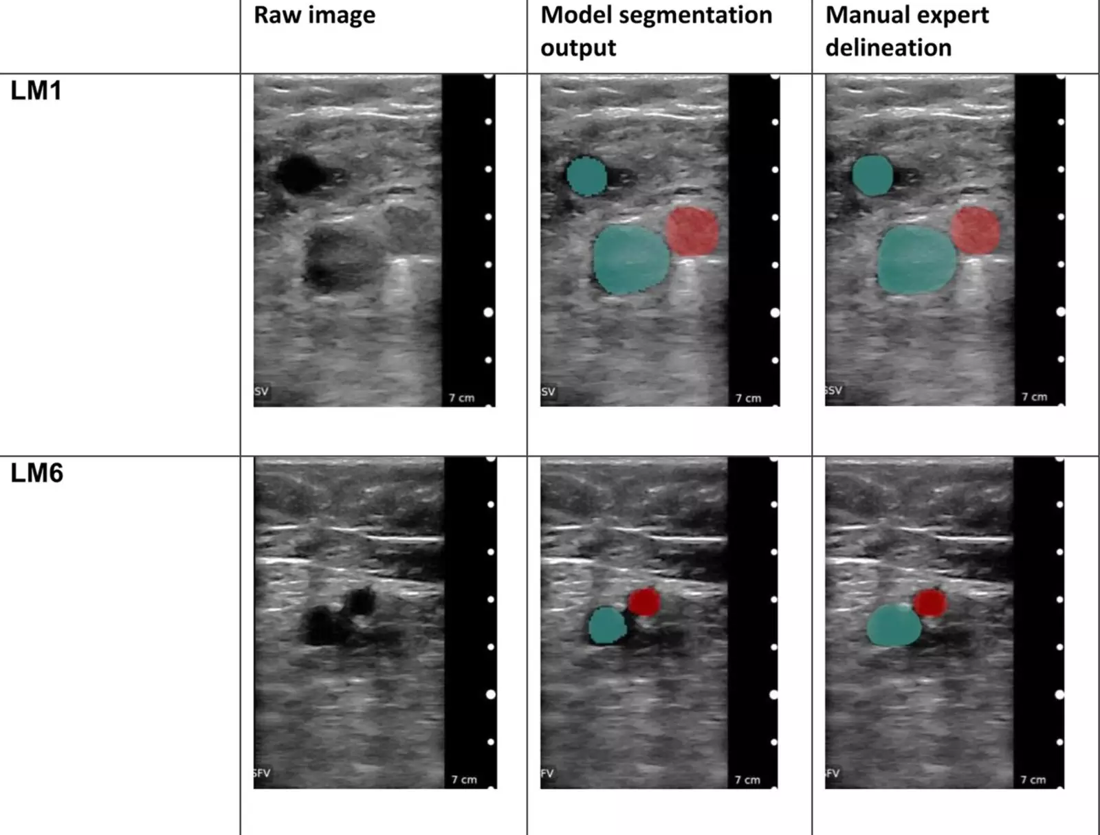 Машина точно диагностировала все случаи тромбоза. Машина точно диагностировала все случаи тромбоза.