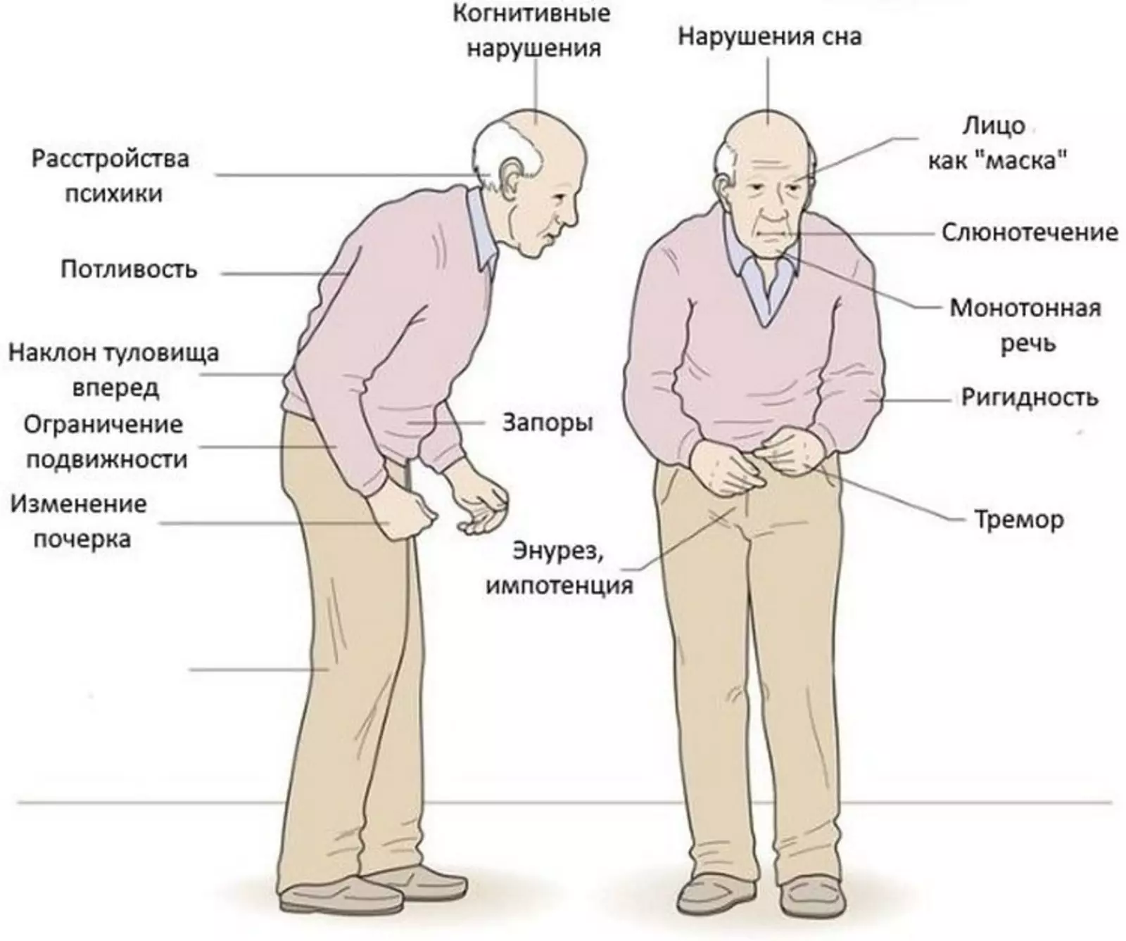 Паркинсон продолжительность жизни. Синдром паркинсонизма симптомы. Клинические синдромы при болезни Паркинсона. Болезнь Паркинсона симптомы и признаки у пожилых. Паркинсон проявления.