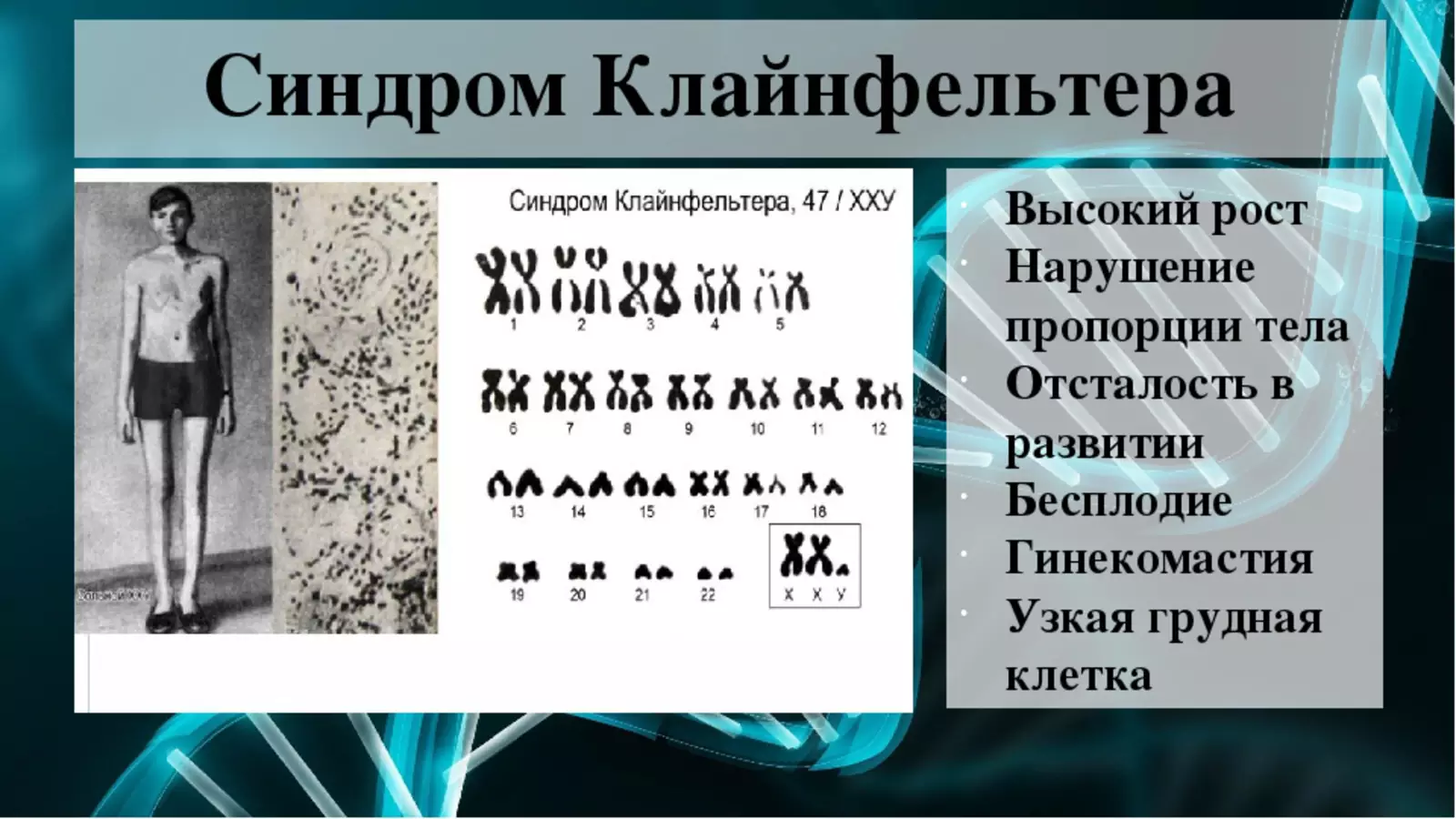 Xxy хромосома. Синдром Клайнфельтера 47 xxy. Синдром Клайнфельтера кариотип. Синдром Клайнфельтера (у мужчин 47 хромосом -ХХУ). Хромосомная формула Клайнфельтера.