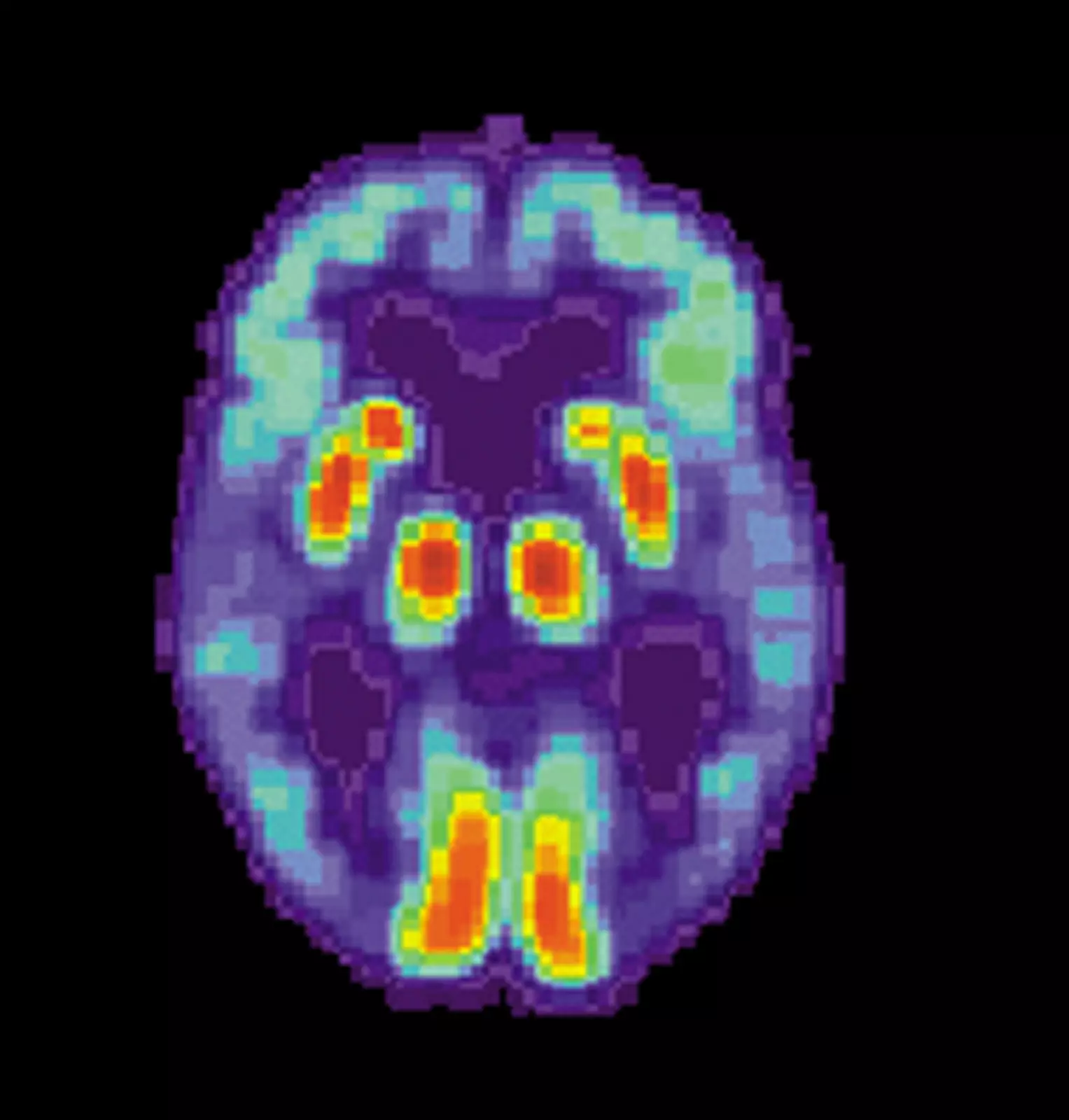 МРТ-снимок мозга человека с болезнью Альцгеймера.