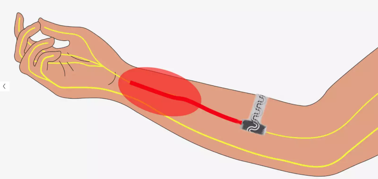Устройство безвредно растворяется, когда в нём больше нет необходимости. Устройство безвредно растворяется, когда в нём больше нет необходимости.