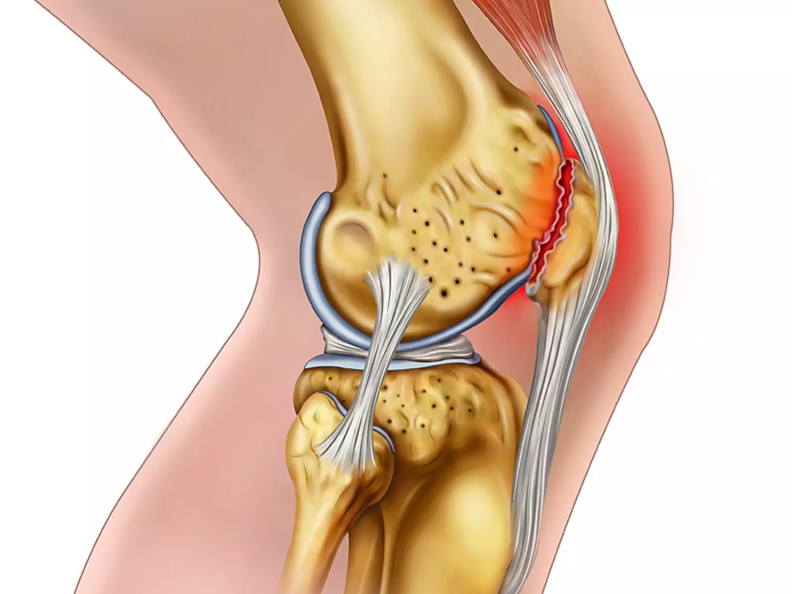 Связка мениска колена. Разрыв мениска коленного. Внутренний менисцит коленного сустава. Мениск коленной чашечки что это такое.