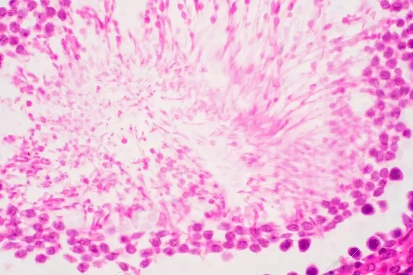 Для того, чтобы стать отцами, мужчинам с бесплодием приходится пожертвовать ткань яичка со здоровыми сперматозоидами.