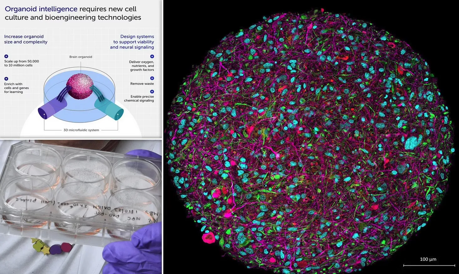 На фото увеличенное изображение выращенного в лаборатории органоида головного мозга с флуоресцентной маркировкой для различных типов клеток (нейроны заштрихованы розовым цветом).