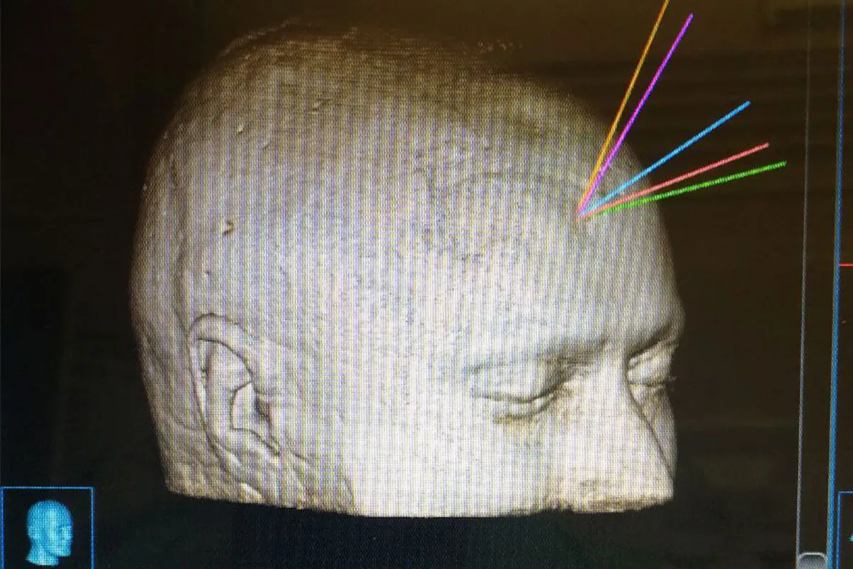 Лазерная операция 