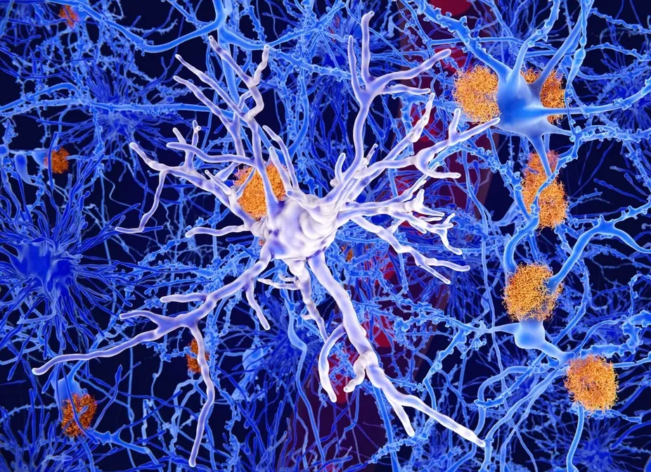 Амилоидные бляшки (оранжевые) влияют на образование микроглии в головном мозге.