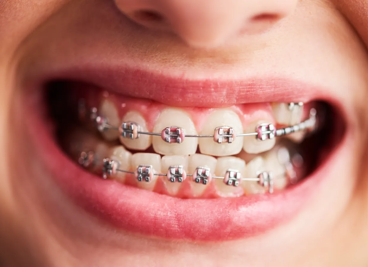 Часто брекеты могут натирать слизистую оболочку рта. 