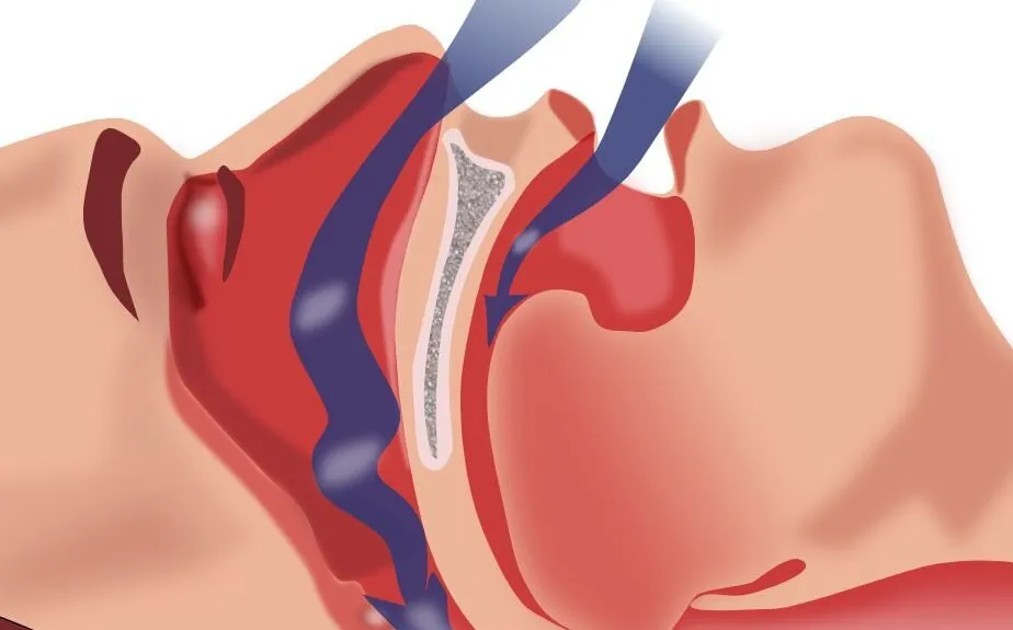 Апноэ во сне.
